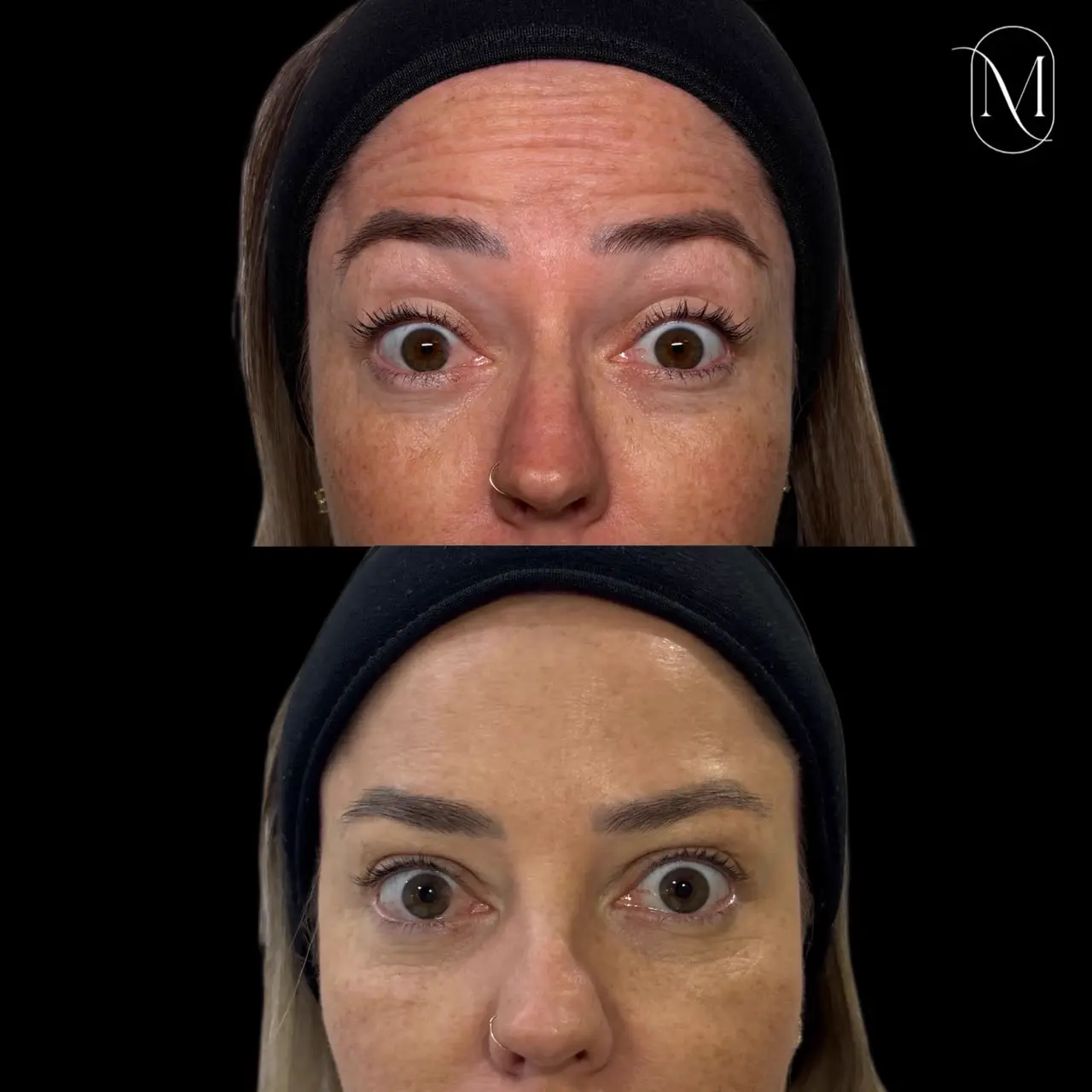 Harmonização facial — olhar renovado