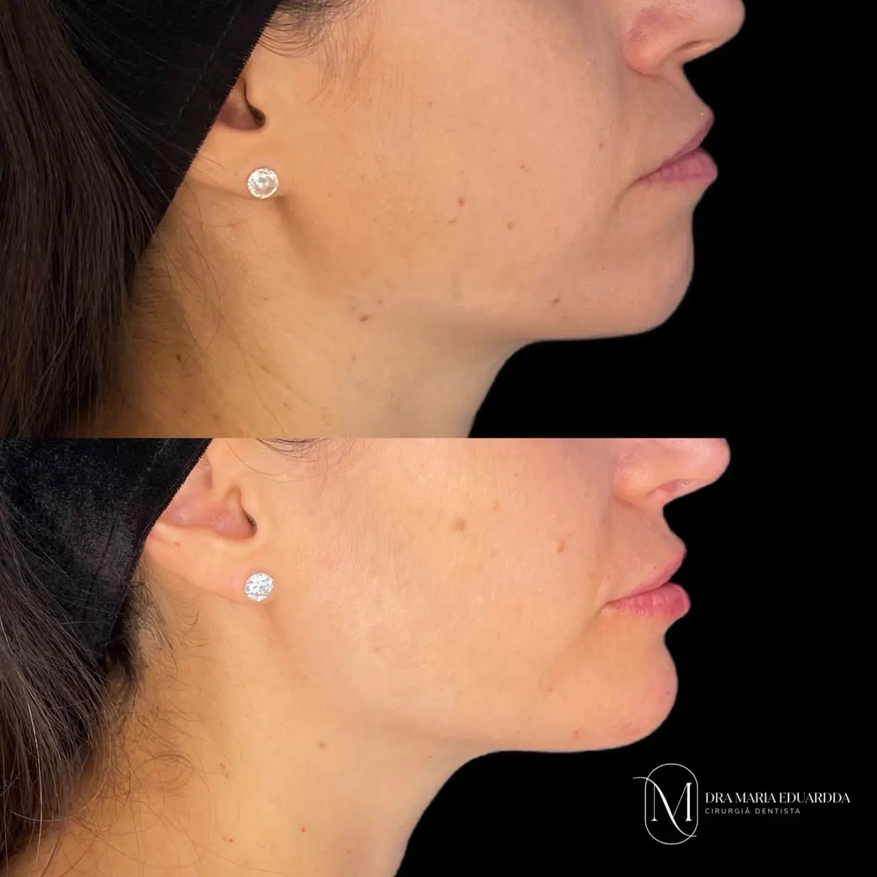 Harmonização facial — contorno de perfil