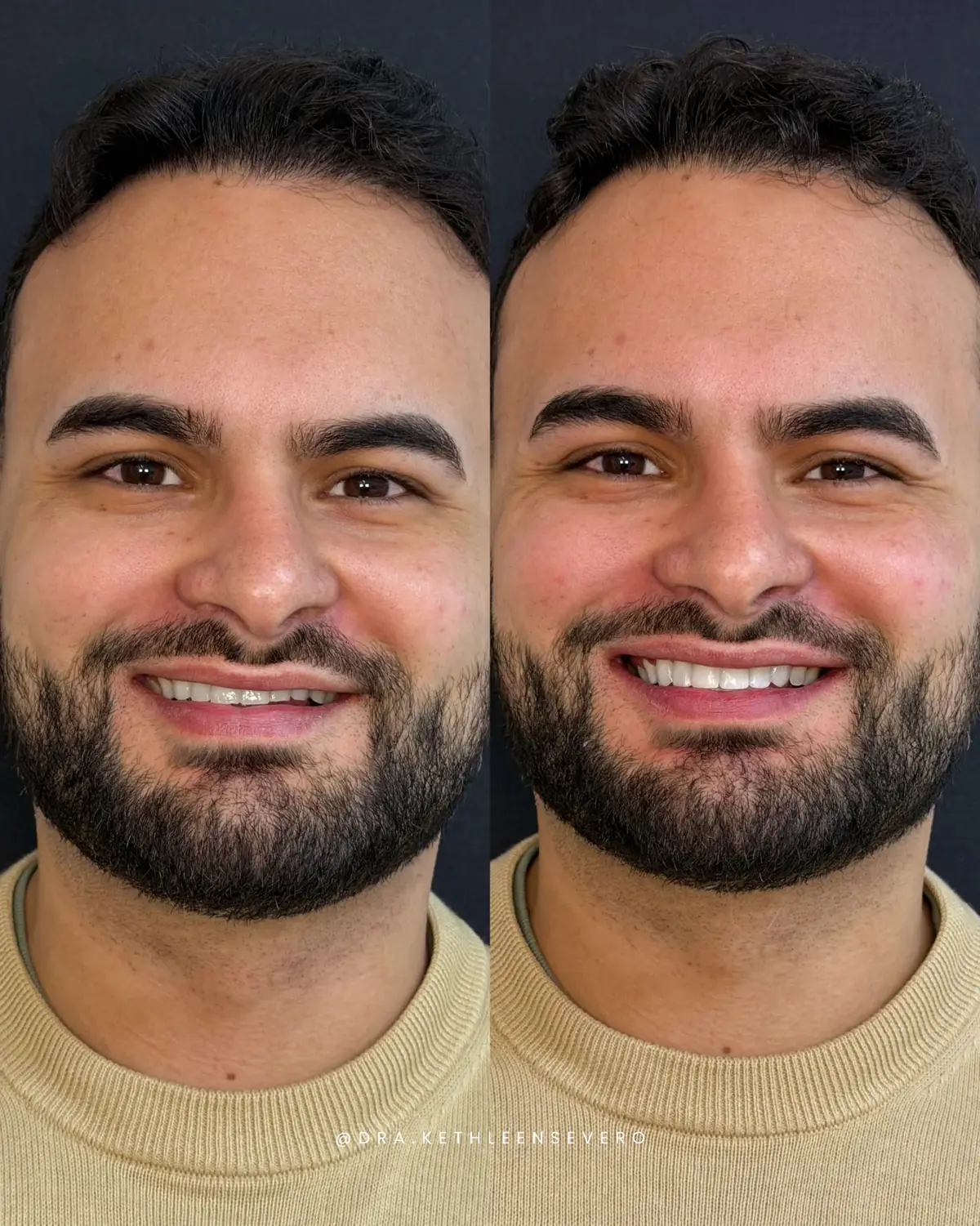 Sorriso — reabilitação estética