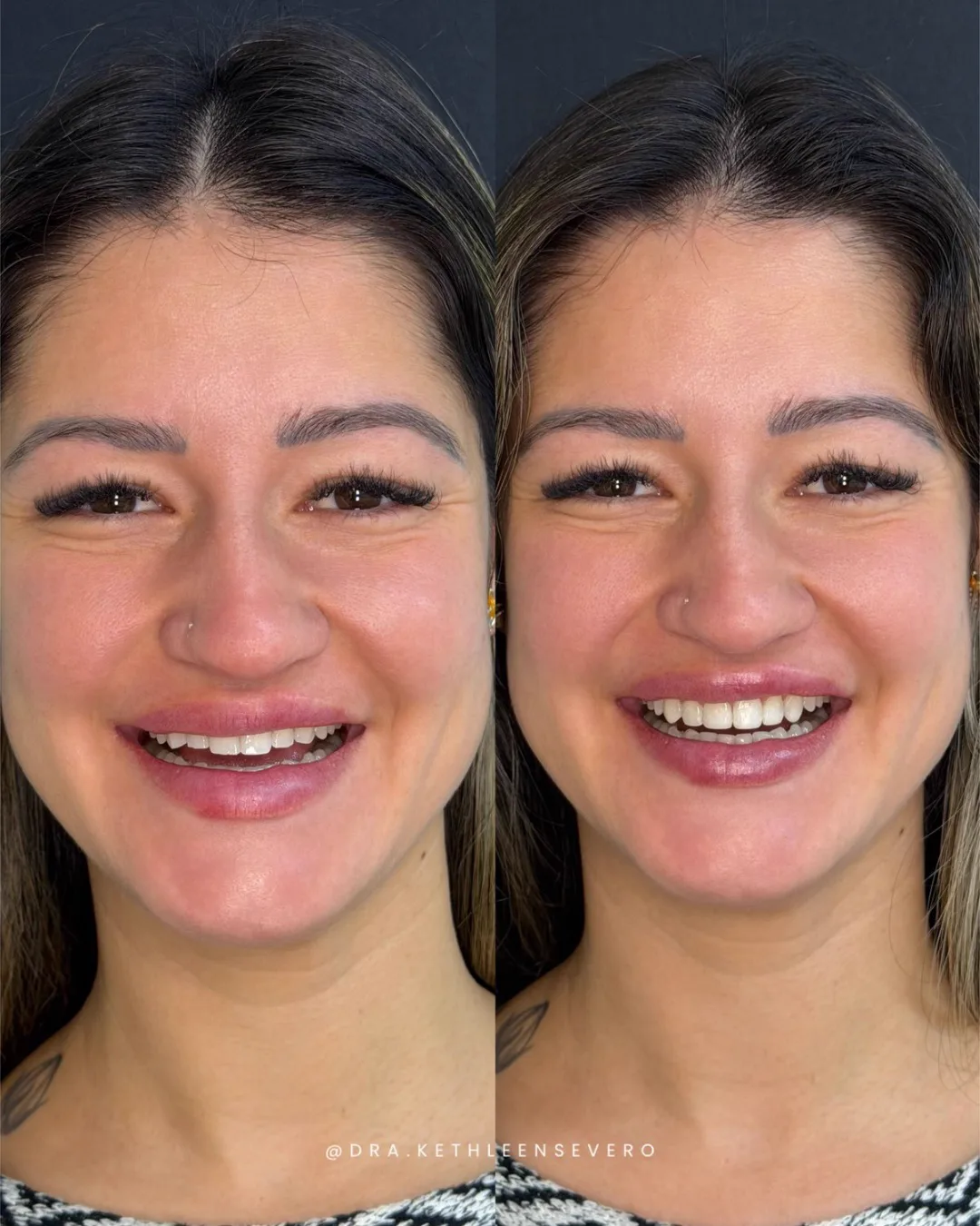 Sorriso — harmonização
