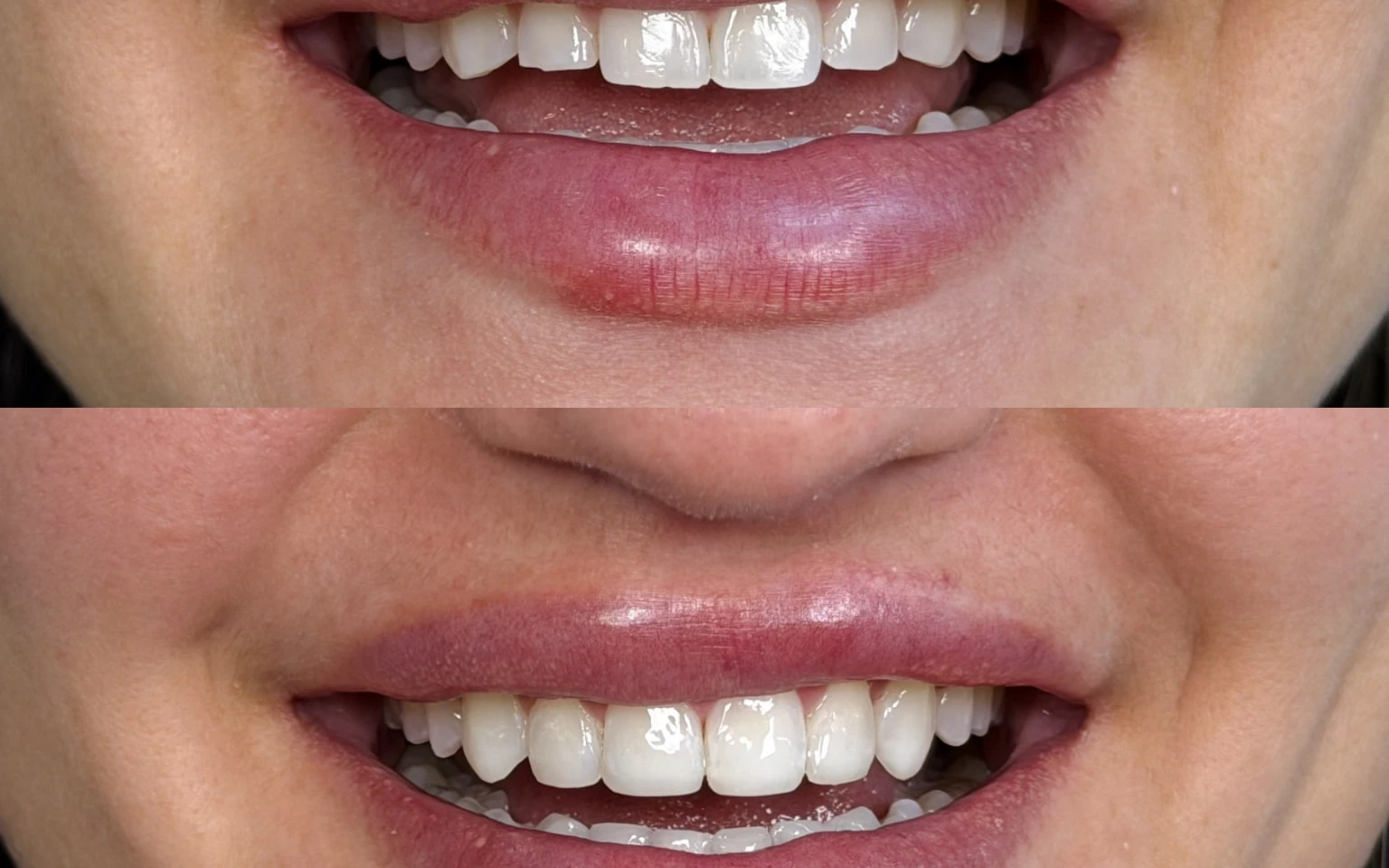 Sorriso com facetas e lentes de contato dental de porcelana