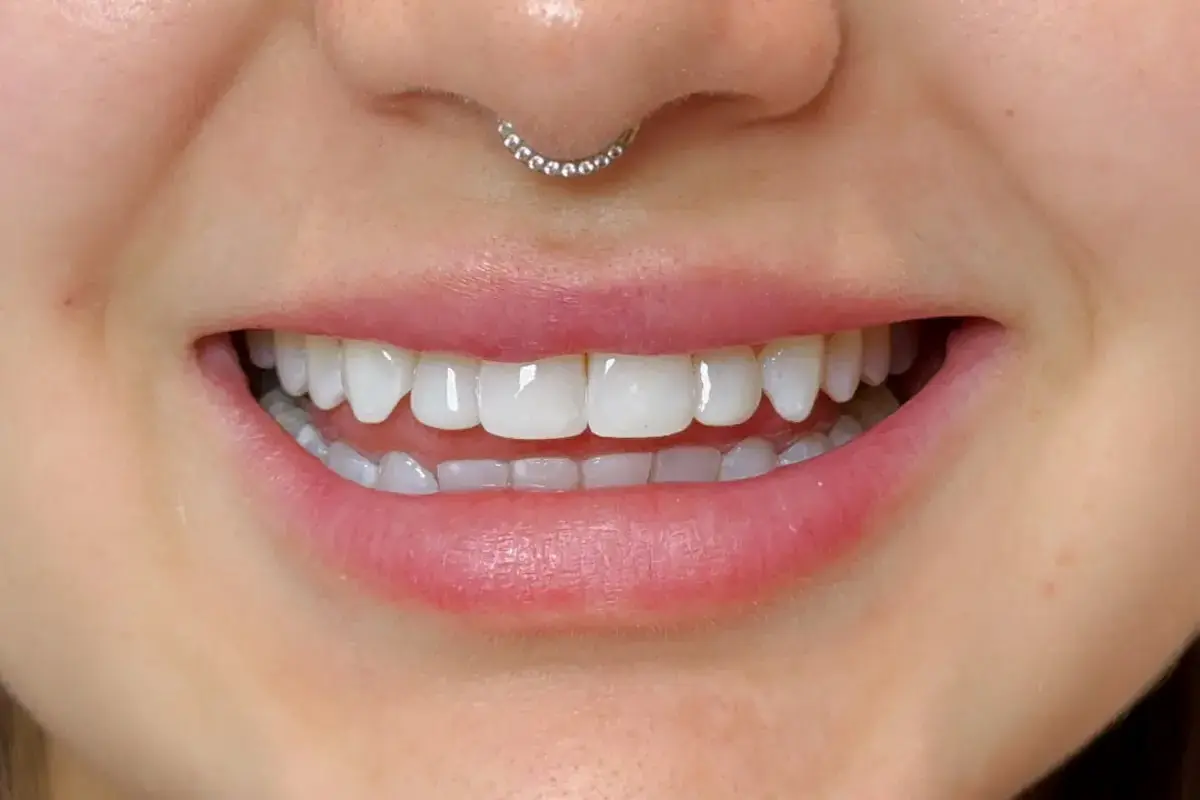 Sorriso com facetas de porcelana naturais e brilhantes