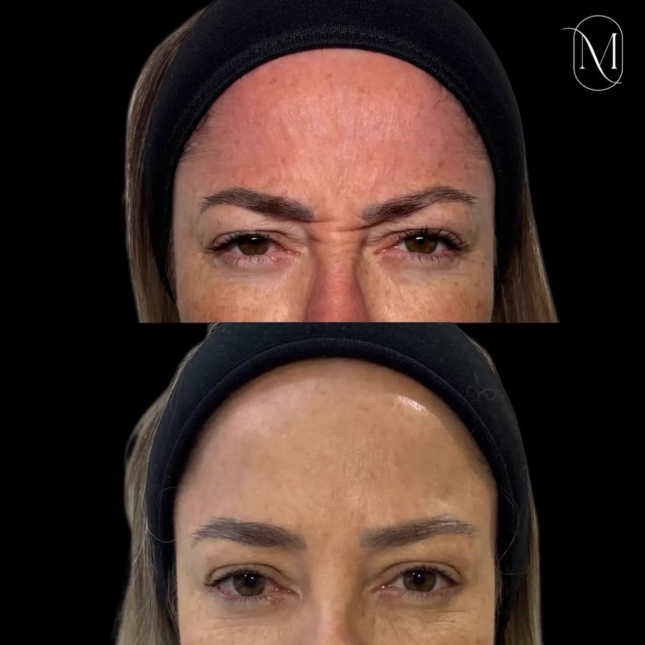 Harmonização facial — linhas de expressão suavizadas